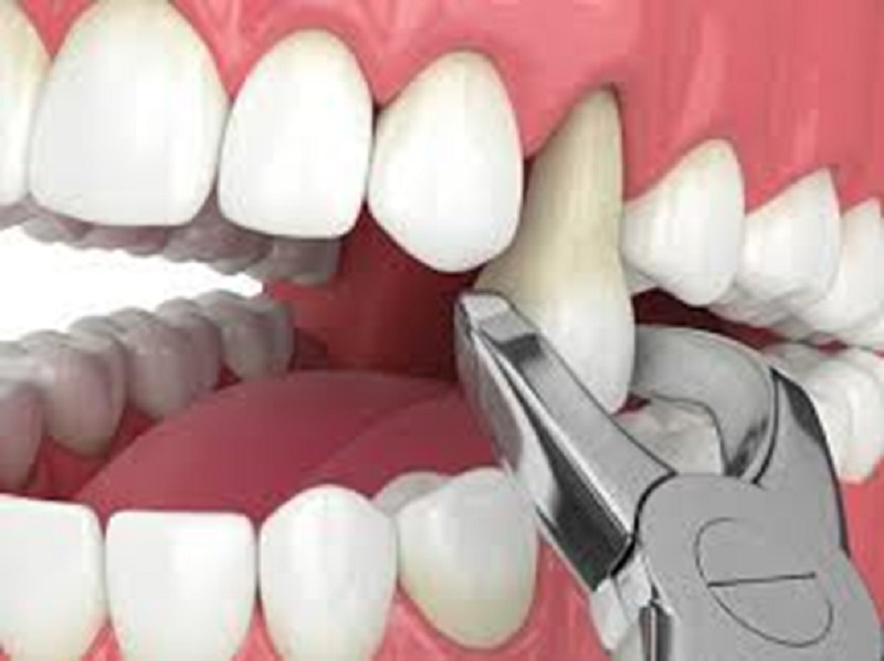 How Is Tooth Extraction Treatment Performed?