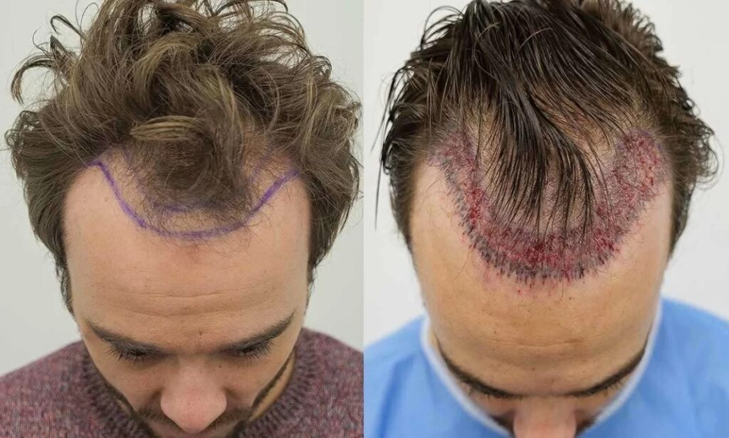 Does Hair Transplant Provide The Permanent Results?